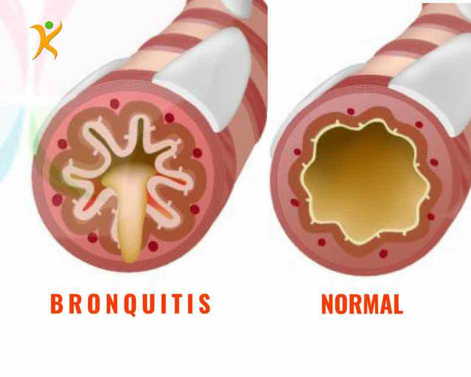 bronquitis