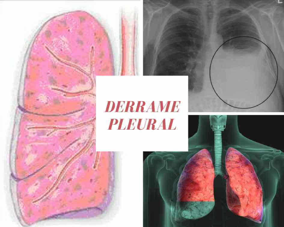 derrame pleural